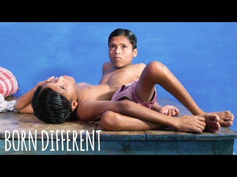 Video: Indian Siamese Twins Shivanath And Shivram - Alternative View