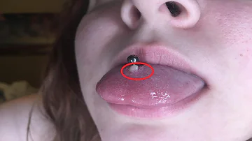 how to get rid of a tongue piercing bump