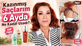 Dazlak Kafada, Doğru Bakımla ,Saç Nasıl Sağlıklı Ve Hızlı Uzar ?