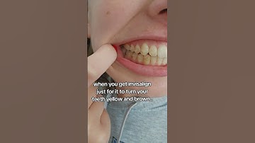 How to Prevent Stains on your Invisalign Attachments