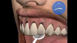 Root Tip Resection with orthograde filling