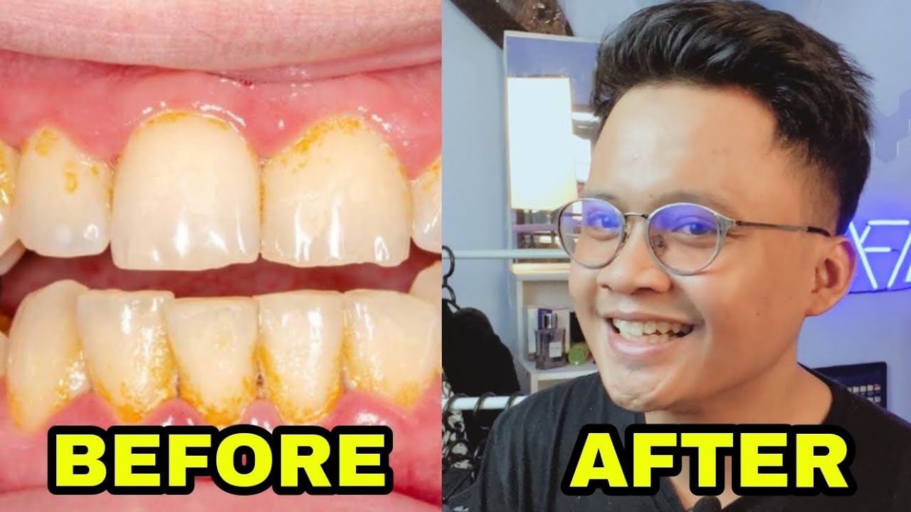 Cara Menghilangkan Karang Gigi Yang Sudah Mengeras di Klinik UB Malang