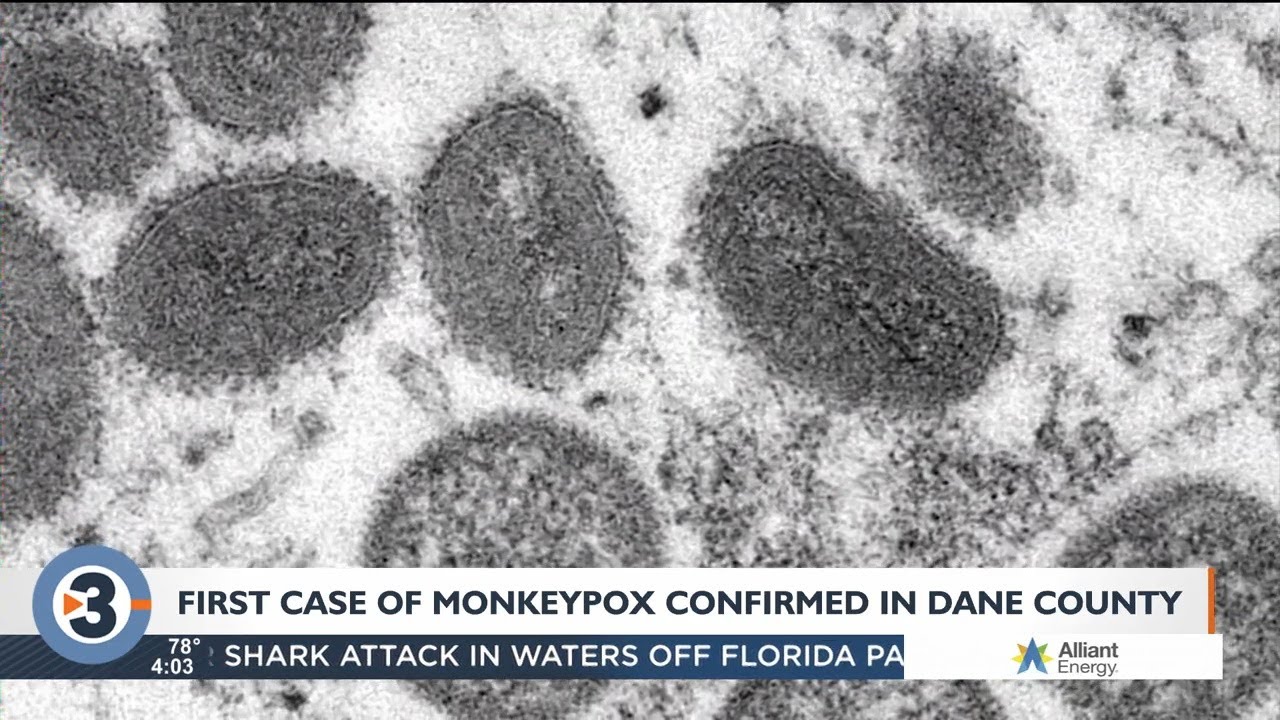 DHS: Wisconsin's first case of monkeypox confirmed in Dane County