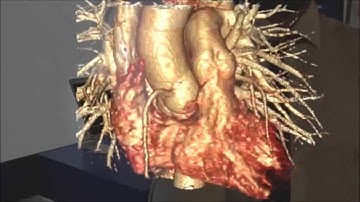 AR Vizua Plateform and Microsoft Hololens - Animated Heart at JFR