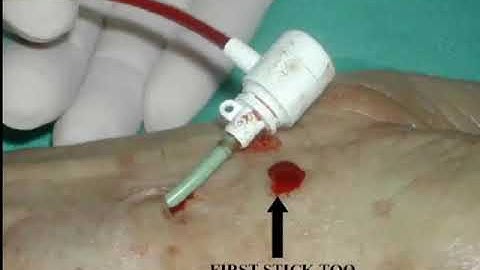 Mở đường vào động mạch theo dõi huyết động xâm nhập