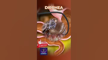 Diarrhea Formation: Causes, Mechanism, and Prevention Explained
