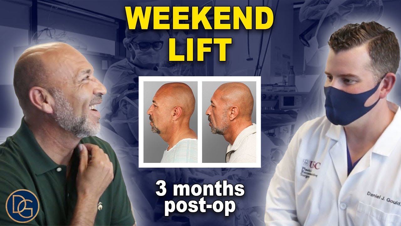 3 Months After a Weekend Lift | What to Expect