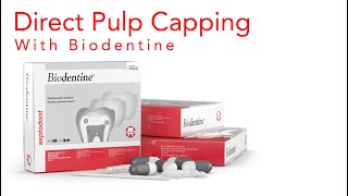 Biodentine Direct Pulp Capping  Improve Pulp Capping Success Rate | Techniques and Material 2022