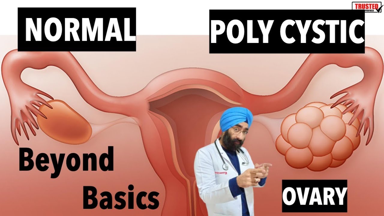 Polycystic Ovary | PCOD | PCOS | Explained Beyond Basics | Dr.Education
