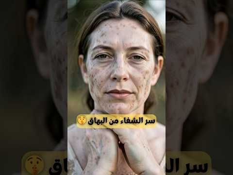 فيتامينات ضرورية لعلاج البهاق وتوقيف هجوم المناعة وصفة مهمة