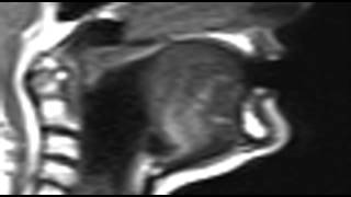 Ultrax MRI alveolar ejective