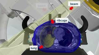 External beam radiotherapy - a common treatment for breast cancer