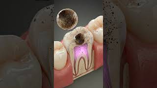 What Happens When You Stop Brushing  Cavity Formation Explained 3d Animation