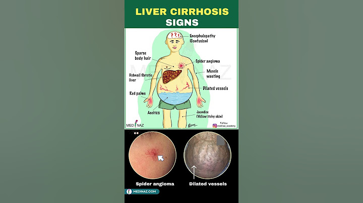 Signs of Liver Cirrhosis | Cirrhosis of the liver | Liver Disease #cirrhosis #shorts #liverhealth