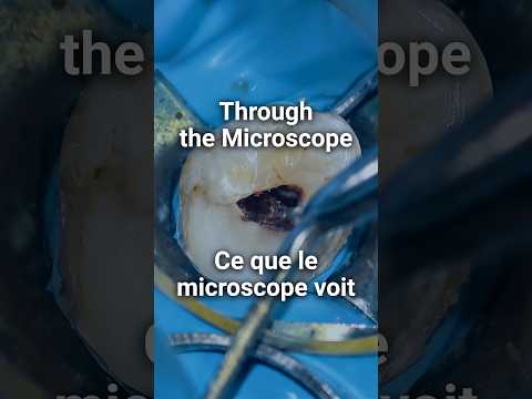 iSee Pro: Calcified Canal Case | iSee Pro : Localisation d’un canal calcifié