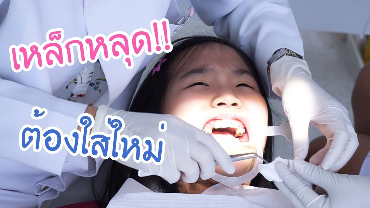 เหล็กจัดฟันหลุด!!! | AiDesign