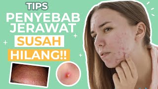 JANGAN LAKUKAN! 5 Kesalahan Besar Menghilangkan Jerawat!