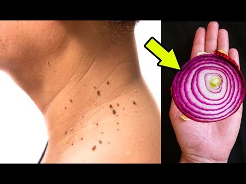 Remove Skin TAG Overnight With Kitchen Ingredient Remedy ( 100% WORKING) everyday culture