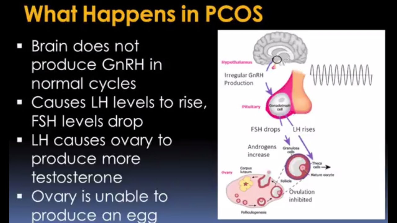 Download Understanding Polycystic Ovary Syndrome Video – Brigham and Women’s Hospital