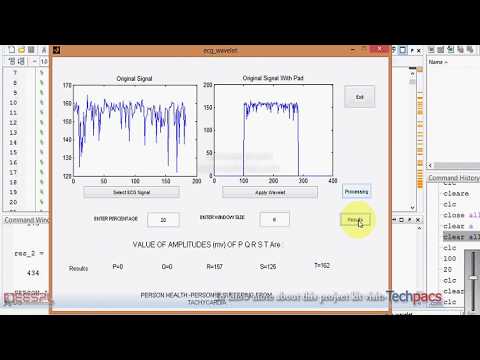Peak classification approach in ECG signal for determining various diseases (latest Project 2020)