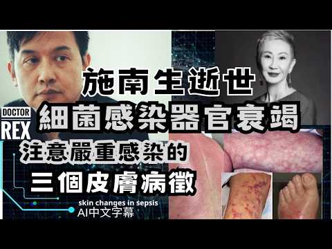 施南生女士細菌感染器官衰竭辭世: 三個人人都應該知道的嚴重感染皮膚病徵