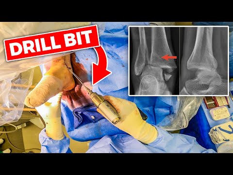 INSIDE THE OR: Ankle Fracture Open Reduction Internal Fixation (Surgical Video) thumbnail