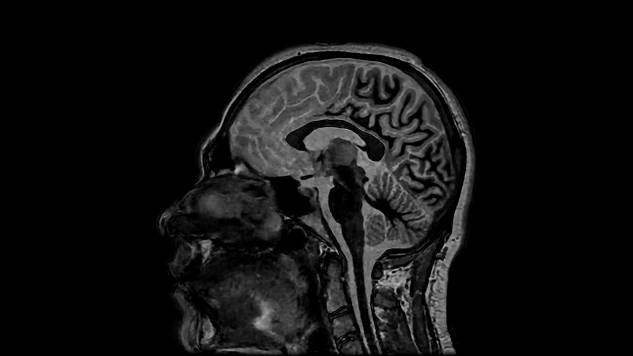 💢3D Axial BRAVO White Matter Nulling with HyperSense & AIR Recon DL