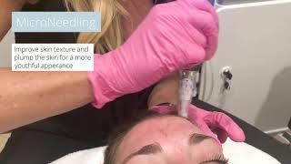 MicroNeedling