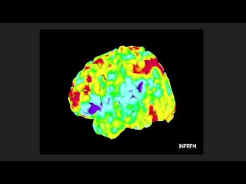 Vídeo: Comparación De Los Conectomas Cerebrales Por Resonancia Magnética Y Genómica Y Su Implicación En La Enfermedad De Alzheimer