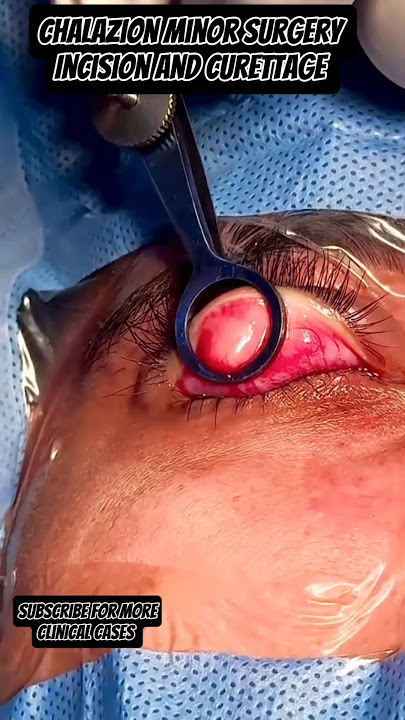 Download lagu Chalazion Removal Surgery|Incision and Curettage|Eye Cyst Removal #Chalazion #stye #eyes