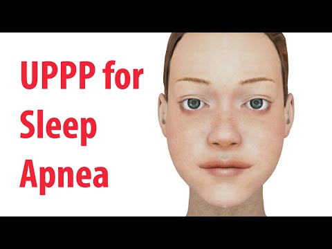 Uvulopalatopharyngoplasty (UPPP) for Sleep Apnea in Adults