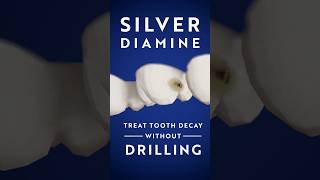 How to treat a tooth with silver diamine fluoride (SDF)
