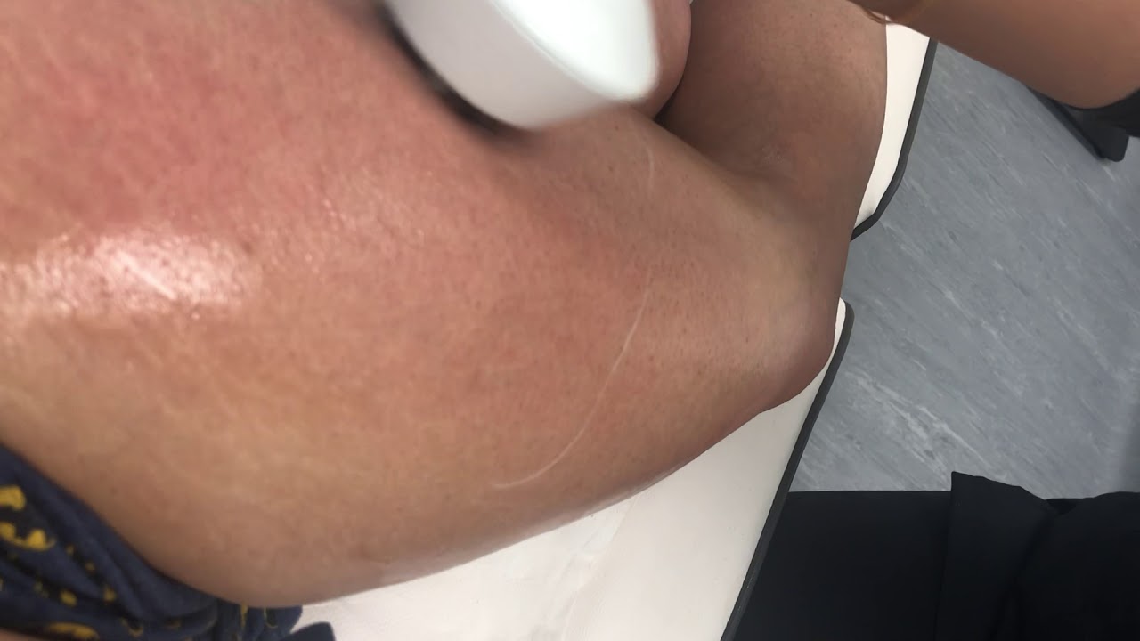 Lipofirm Pro at MySkyn Clinic in Bradford