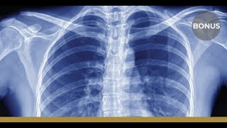 Cant Miss X-rays in Urgent Care Part 1 (Chest X-ray) - A Frank Discussion (MC CME Podcast)