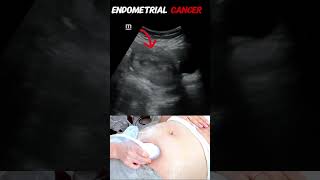ultrasound showing Endometrial cancer (carcinoma) #ultrasound #shorts #gynecology