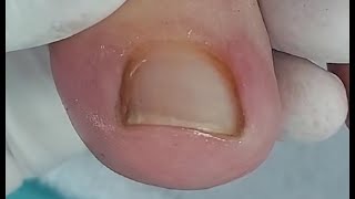 Adeus, unha encravada! Olha a diferença. 👣