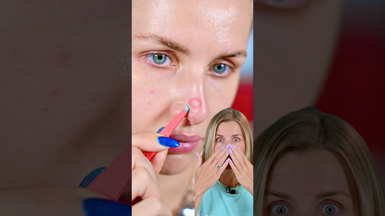 Разочаровалась! Патчи от Прыщей с Иглами!