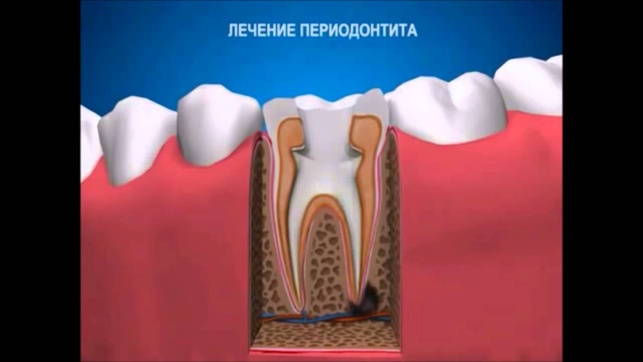 Лечение периодонтита Терапевтическая стоматология - YouTube