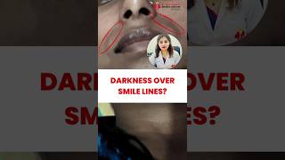 How to treat Darkening over Smile Line?