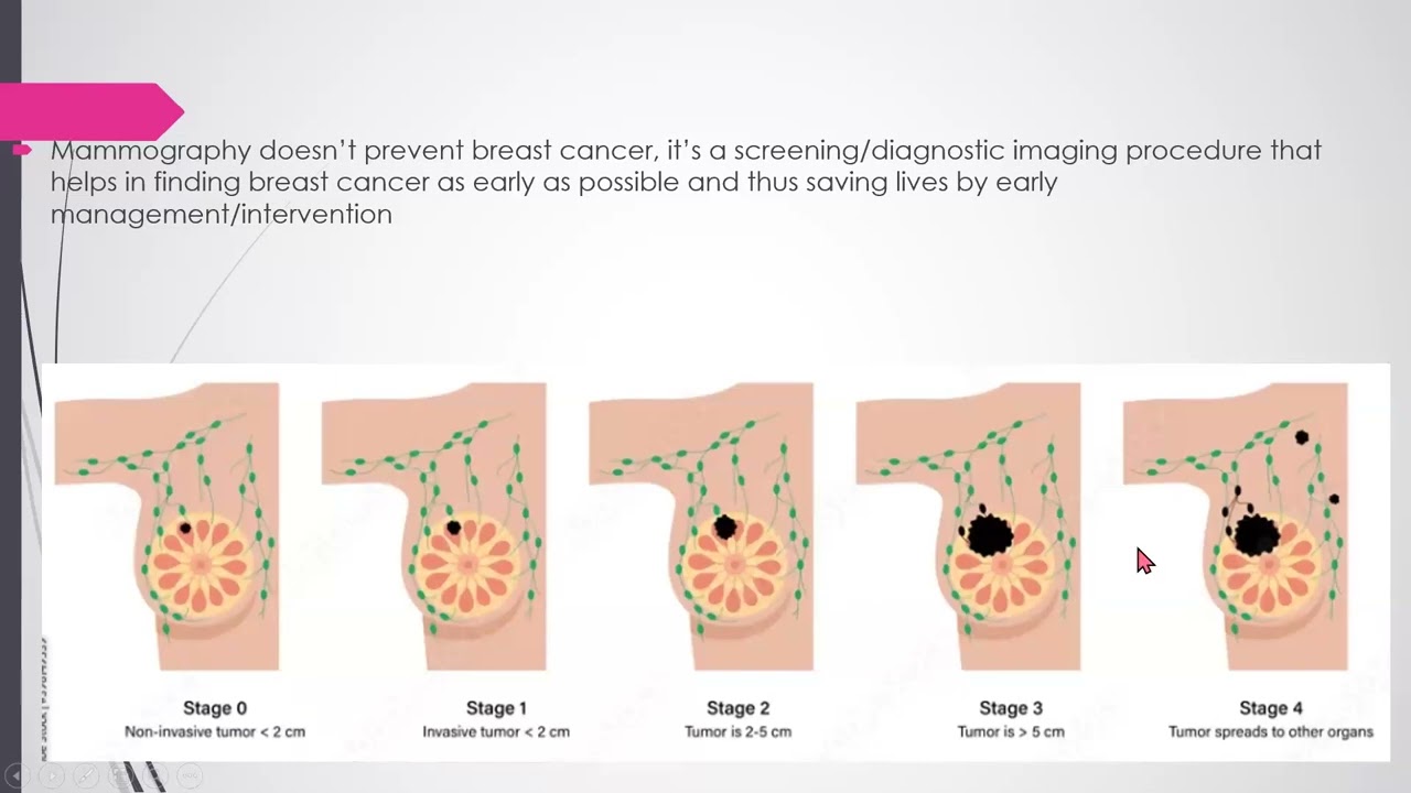 Mammography as a Screening tool in in Diagnosis of Breast Cancer 15.10.25