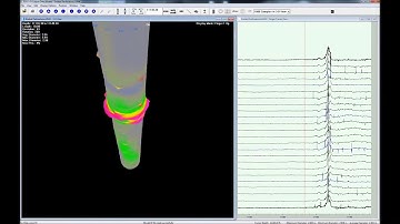 Perforation Inspection with Multi Finger Caliper
