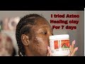 I AM SHOOK \\ I TRIED AZTEC HEALING CLAY ON MY ACNE FOR 7 DAYS