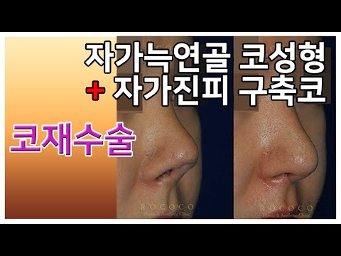 급속교정 코성형 - 자가늑연골 + 자가진피 구축코 코재수술 사례 .feat.전후사진 (/beforeAndafter)
