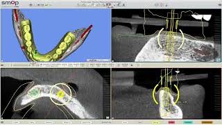 Smop: How to Add Two Implants to Overdenture Case