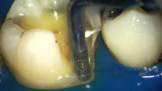 Indirect composite restoration