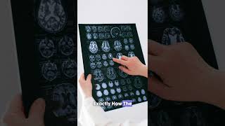 MRI Results? What Does It Really Mean? #MRI #diagnosis #shorts