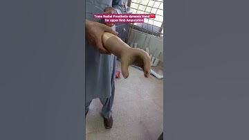 Transradial Prosthetic Dynamic Hand | Life After Upper Limb Amputation