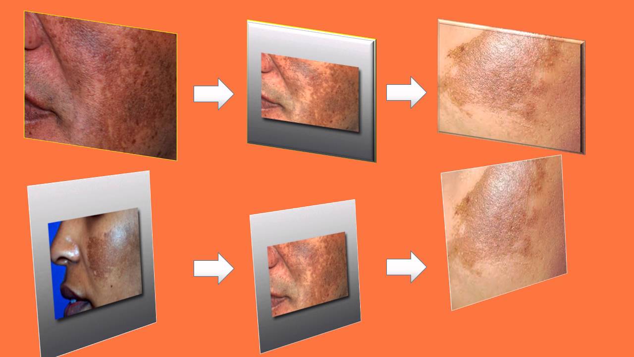 Skin Whitening Video YouTube