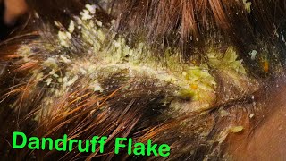 Flakes take flight! | Bonus Footage |  Dandruff Scratching