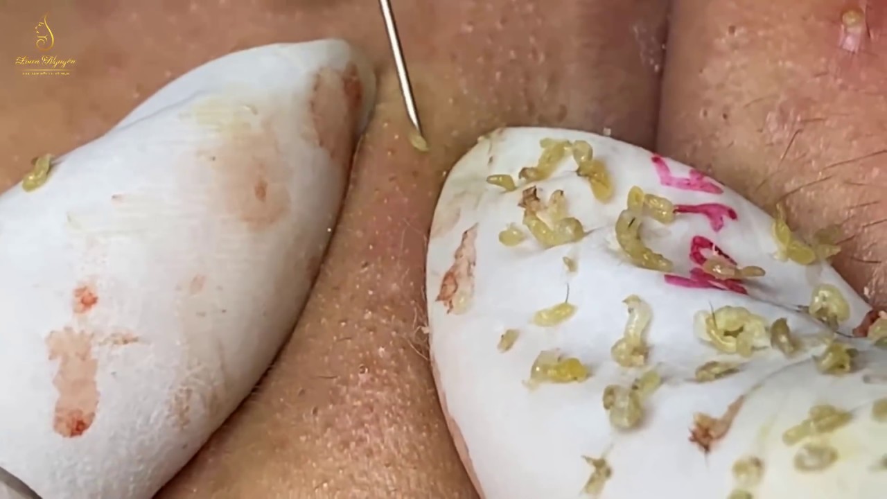 Pimple Popper Pops Best Blackhead  In New (157) | Loan nguyen